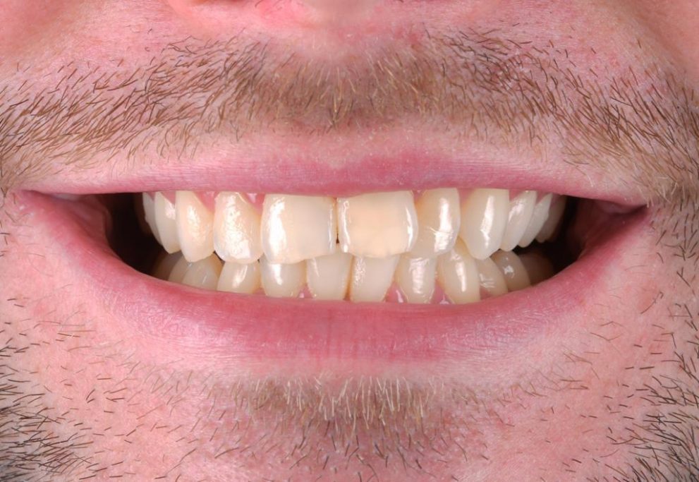 Composite Veneers 1 Pre